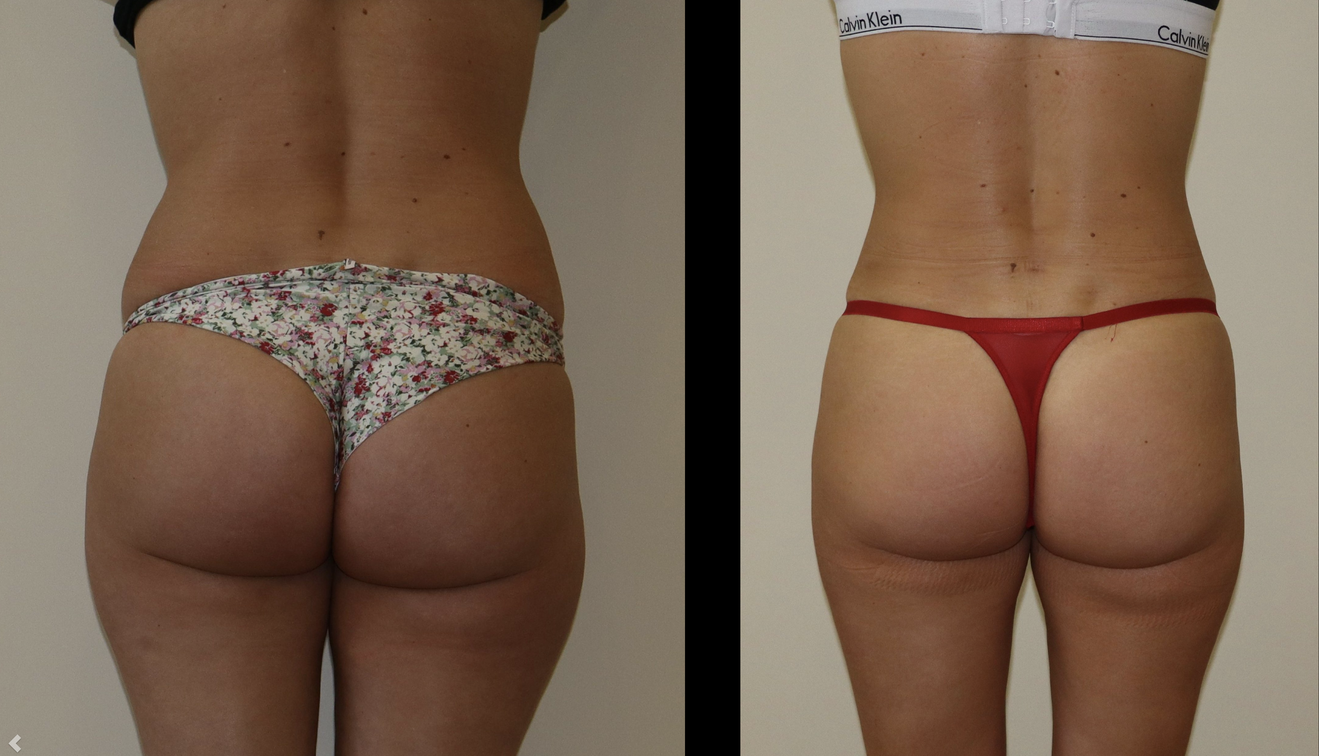 Avant/Après lipoaspiration flancs abdomen